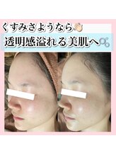 アルムダアクア 天王寺店(Aleumda AQUA)/ハーブピーリング/大阪/天王寺