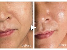 ムク(MUKU 無垢)の雰囲気（セラピール施術後のbefore/after）