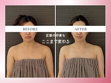 リスブランビューティー(Lys Blanc Beauty)/９０分コルギBefore×After