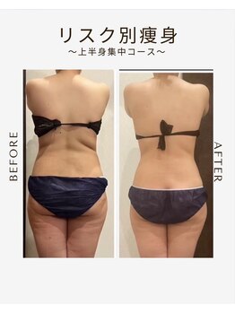 ビーシェイプ 君津(B-Shape)/【痩身】ビフォーアフター