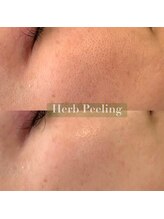 アロー(Allo!)/高濃度炭酸＋ハーブピーリング