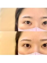 ベル フルール(Bell Fleur)/セット施術前後