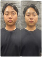 長寿鍼灸院 長寿整骨院/men's美容鍼50本効果★