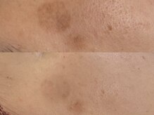 ベアール(beal)/シミ特化ハーブピーリング4回