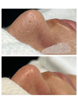 カスミ(KASUMI)/毛穴吸引