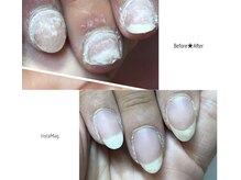 深爪、噛み爪、ケアや補強で強く（お問い合わせください）