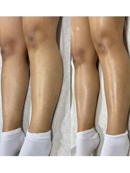 シアージュ(ciage.)/【WAX脱毛】腕トータル