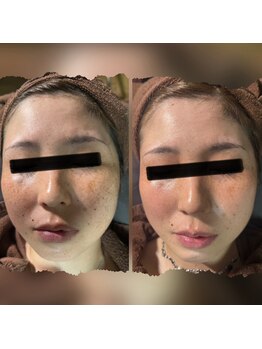 パシテア(Pasithea)/BBLフェイシャル