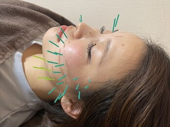 たくみ整骨院 綱島西口院の写真/話題の美容鍼でお顔の巡りやたるみが改善し、自然に小顔に◎肌の内側に働きかけ、肌艶や新陳代謝もアップ♪