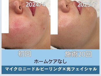 アロマ(AROMA)/凹凸跡/毛穴/越谷せんげん台