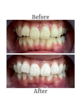 エクシアホワイトニング 相模大野店/ビフォーアフター