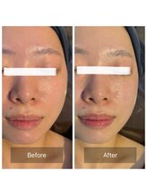 ラビ(RABBI)/20代女性プラチナリフト