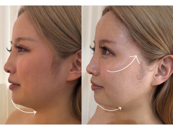 エルドットサナ(L.sana)/小顔矯正