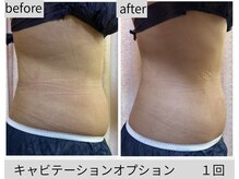 ヴィオテラス(VIOTERACE)/NEW★キャビテーション