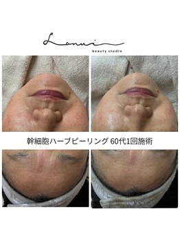 ラヌイ(LANUI)の写真/《お肌の根本改善♪》最新エイジングケア技術で理想のお肌へ！お悩みに寄り添い施術いたします！