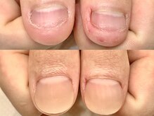 ネイルサロン オー(Oh!)/劇 的☆深爪改善！before→after