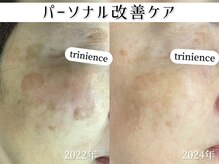 トリニエンス 新宿店(TRINIENCE)/50代/シミケア/パーソナルケア
