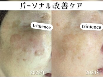 トリニエンス 新宿店(TRINIENCE)/50代/シミケア/パーソナルケア