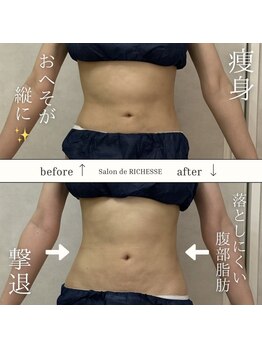 サロンドリシェス(Salon de RICHESSE)/おへその形激変！ポッコリ改善