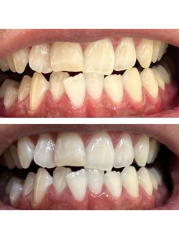 エクシアホワイトニング 郡山店/ホワイトニングビフォーアフター