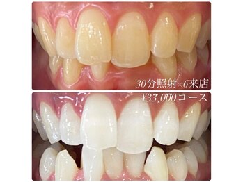 ホワイトニングルーム 横浜店(Whitening Room)/ホワイトニング/横浜