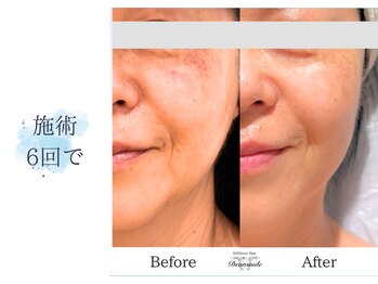 ディアスマイル(Dear.smile)/施術6回で