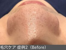 オアシスラグーン(OASIS LAGOON)/毛穴ケア（症例2 before）