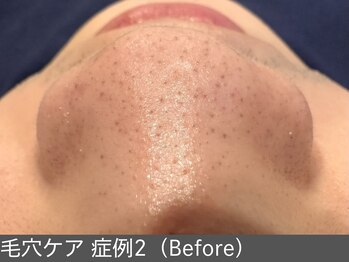 オアシスラグーン(OASIS LAGOON)/毛穴ケア(症例2 before)