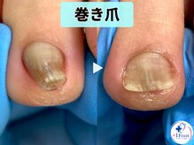 プラスワンフット 本厚木(+1 Foot)/足の人差し指の小さな巻き爪補正