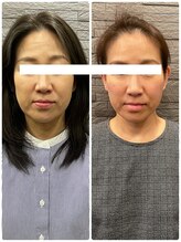 長寿鍼灸院 長寿整骨院/ハリネズミ女優美容鍼効果★