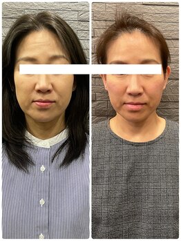 長寿鍼灸院 長寿整骨院/ハリネズミ女優美容鍼効果★