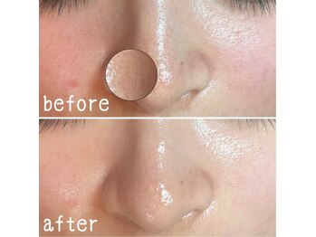 ガーデン(Garden)/毛穴エクストラクション施術前後