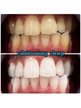 ホワイトニングショップ 京都駅前店/40分×10回Before/After