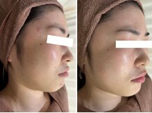 ホワイトアクア 四日市店(WHITE AQUA)/ニキビケア/ニキビ改善/美肌