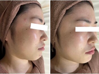 ホワイトアクア 四日市店(WHITE AQUA)/ニキビケア/ニキビ改善/美肌