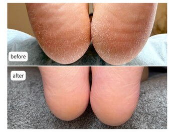 カシェット(Cachette)/30代女性◎足裏角質ケア90分