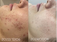 アンリミット 下北沢店(Une limit)/【憧れの韓国肌へ】