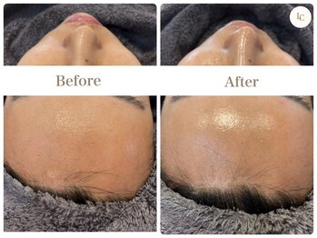 スキンセラピーサロン ル クレール(Le Clair)/Before→After
