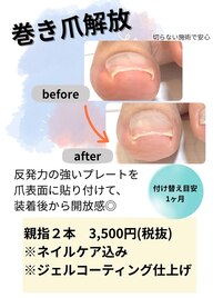 巻き爪ケア