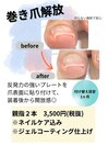 巻き爪ケア