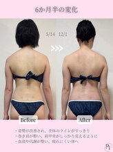 プラスワンビューティテン 新大阪店(Plus One Beauty)/ボディ/ハイパーナイフ/痩身