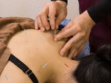 いなほ はりきゅう整骨院 東新宿/鍼灸(吸い玉併用)コース