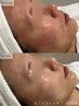 【美白ケア◎】光フェイシャル＋美白&小顔泡パック