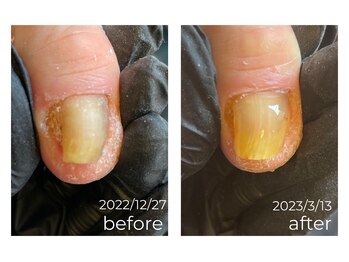 肥厚爪/巻爪ケア《T様右足母趾》