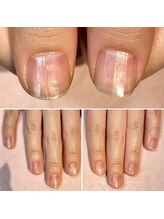 ココデネイル(cocode nail)/悩み:男爪、ささくれ(20代前半)