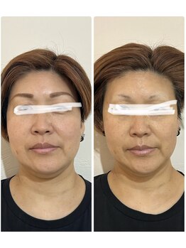 クラティス(CRATIS)/【エルフィーノ】必見次世代小顔