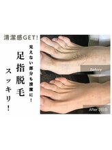 ミラク(MIRAC)/足指脱毛