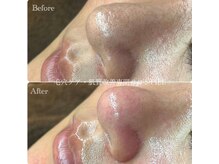 ピエル 北千住店(PIEL)/何度も悩まされた毛穴が綺麗に