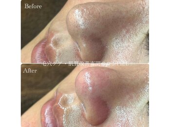 ピエル 北千住店(PIEL)/何度も悩まされた毛穴が綺麗に