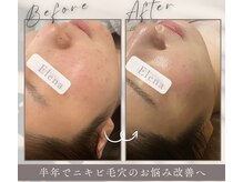 半年間のハーブピーリング・ホームケアでお悩み改善へ☆剥離なし